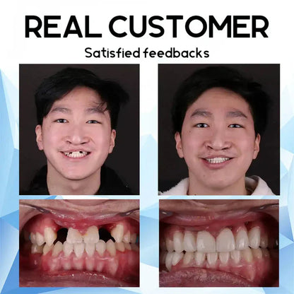 SmilePro™ – Schnapp-Prothesen
