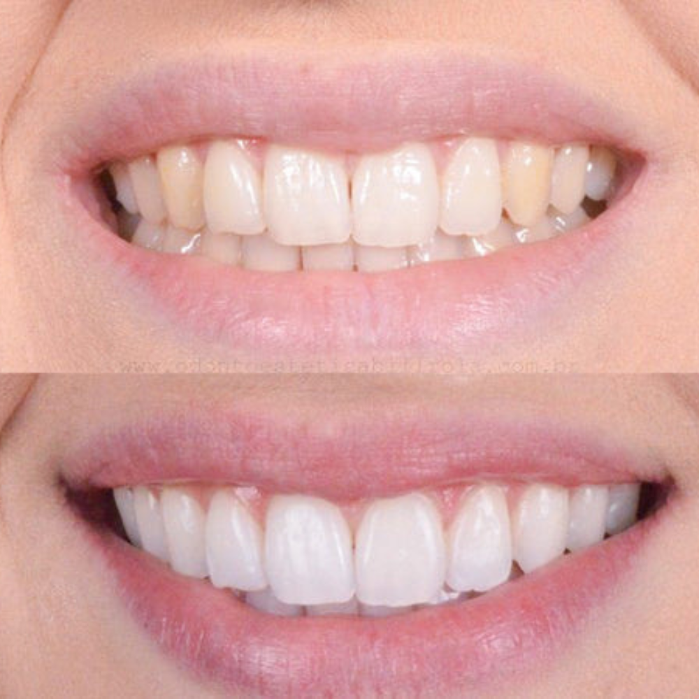WhiteLuxe – Sofortiges Aufhellungsgel für strahlend weiße Zähne | 1+1 Gratis
