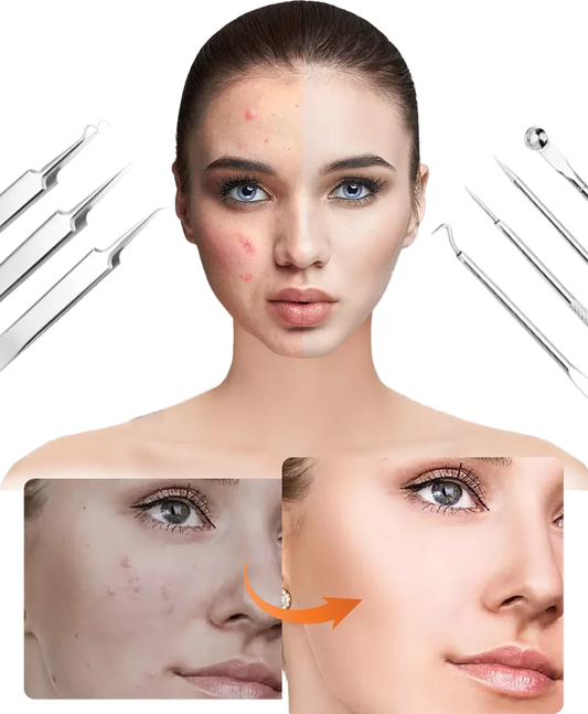 DermaTool™ – Präzise Entfernung von Mitessern