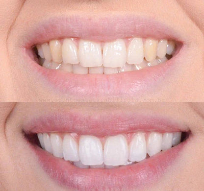 BrightSmile – Zahnweißer für sofortige Aufhellungsergebnisse