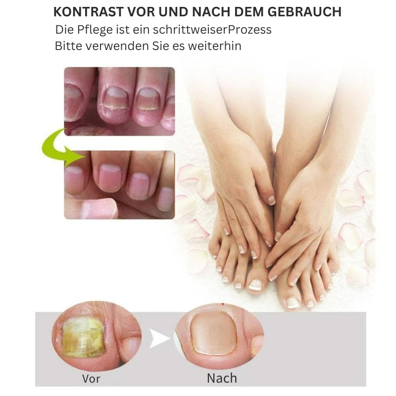 NailRenew - Schnelle Nagelreparaturbehandlung für stärkere und gesündere Nägel | 1+1 Gratis
