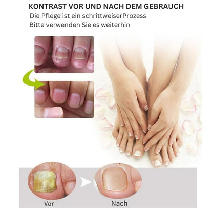 NailRenew - Schnelle Nagelreparaturbehandlung für stärkere und gesündere Nägel | 1+1 Gratis