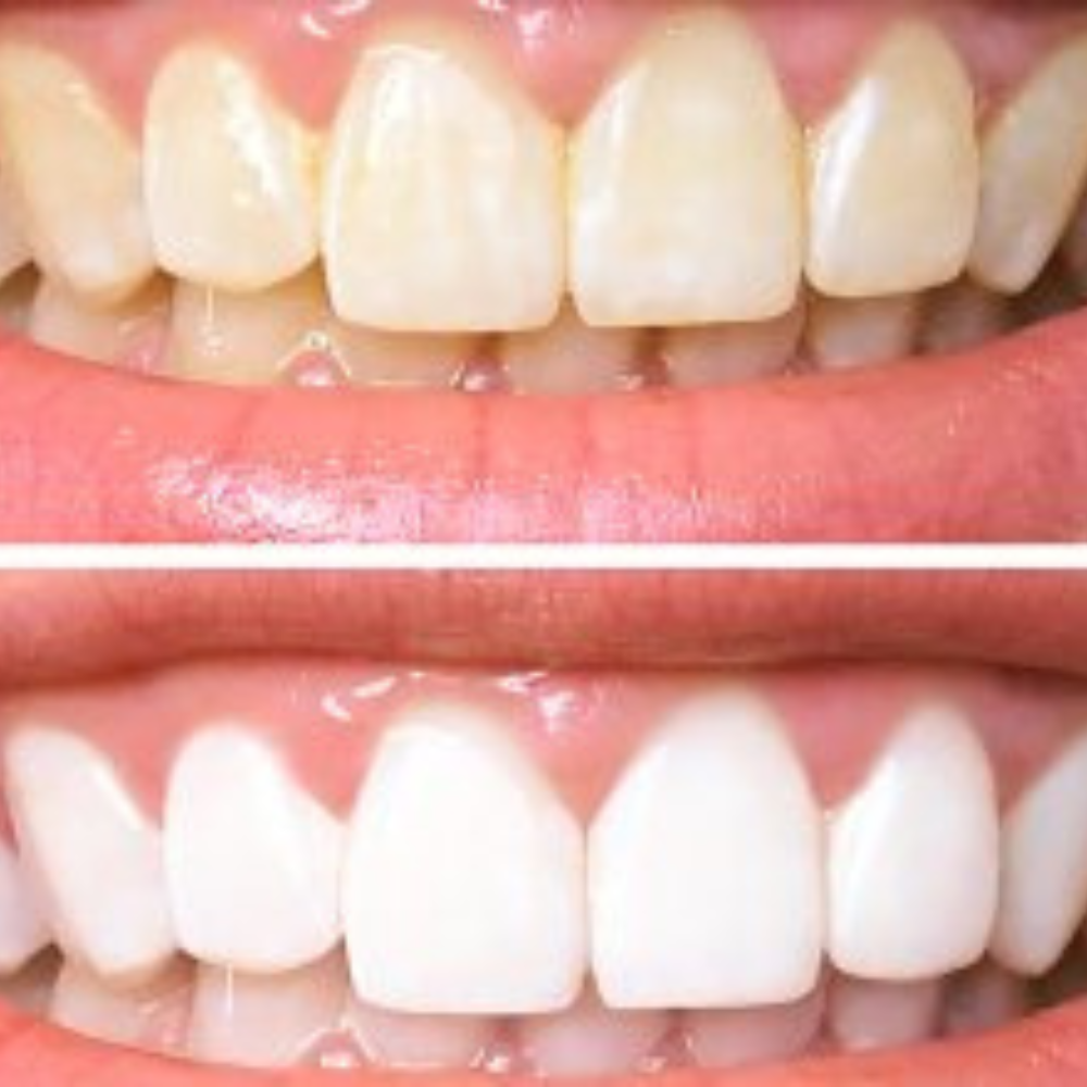 WhiteLuxe – Sofortiges Aufhellungsgel für strahlend weiße Zähne | 1+1 Gratis