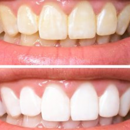 WhiteLuxe – Sofortiges Aufhellungsgel für strahlend weiße Zähne | 1+1 Gratis