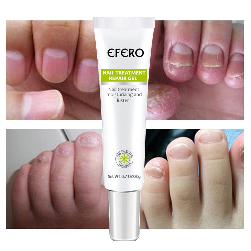 NailRenew - Schnelle Nagelreparaturbehandlung für stärkere und gesündere Nägel | 1+1 Gratis