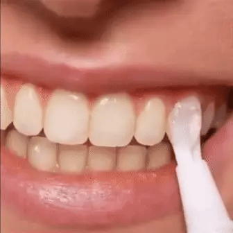 WhiteLuxe – Sofortiges Aufhellungsgel für strahlend weiße Zähne | 1+1 Gratis
