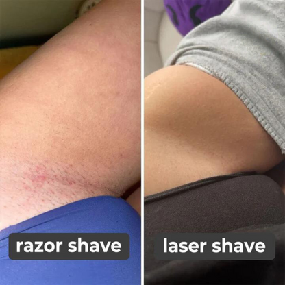 ByHair – Handlaser-Haarentferner für glatte, schmerzfreie Haut