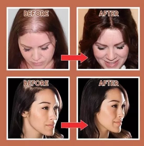 MagicHair – Topper-Clip für natürlich aussehende Haarabdeckung