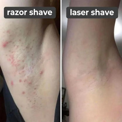 ByHair – Handlaser-Haarentferner für glatte, schmerzfreie Haut